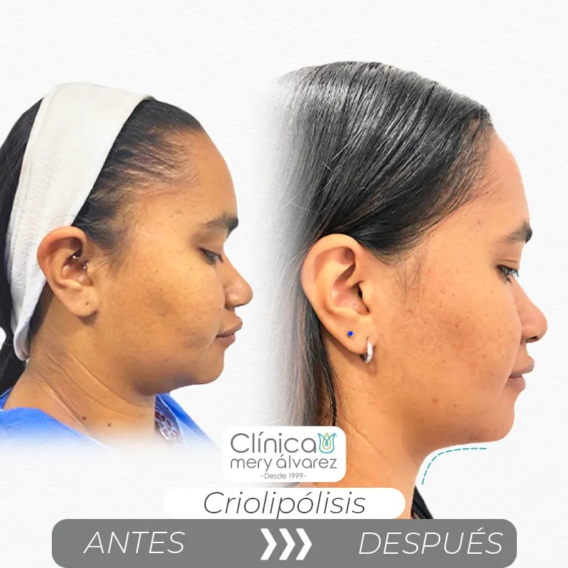 Img-ClinicaMeryAlvarez-Antes-Después-2026-Criolipolisis-1
