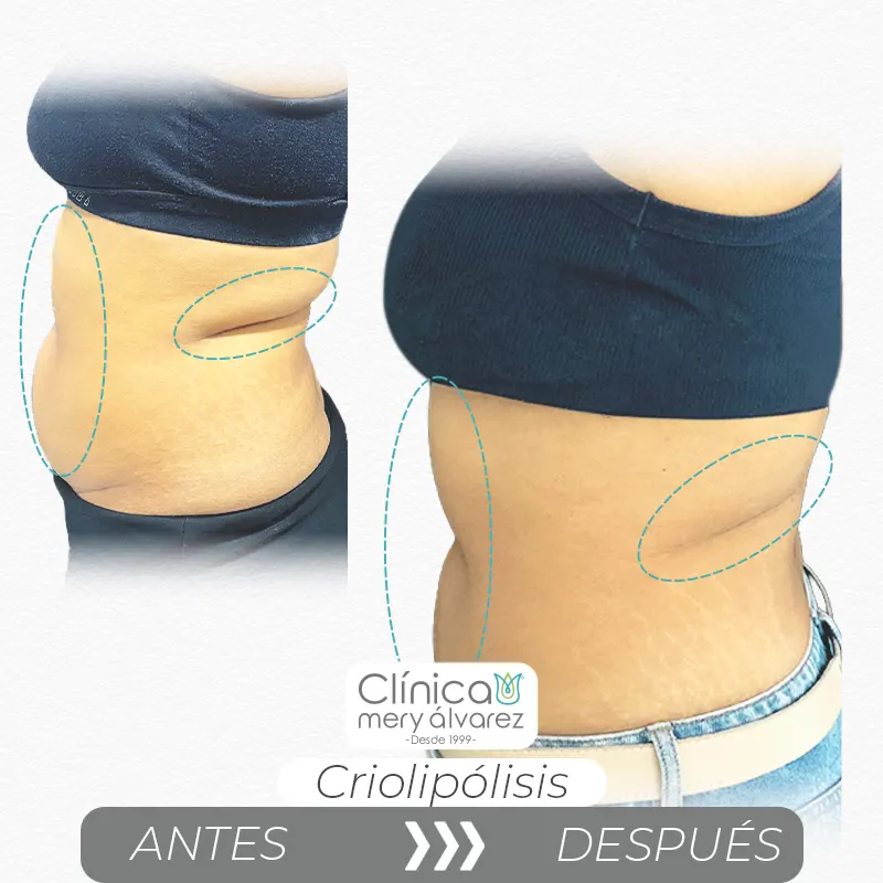 Img-ClinicaMeryAlvarez-Antes-Después-2026-Criolipolisis-2