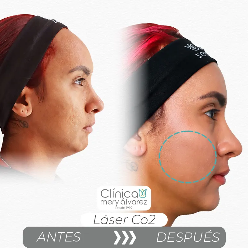 Img-ClinicaMeryAlvarez-Antes-Después-2026-Laser_CO2-1