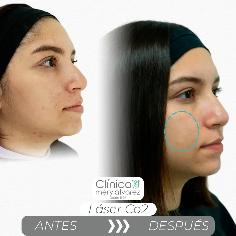 Img-ClinicaMeryAlvarez-Antes-Después-2026-Laser_CO2-2